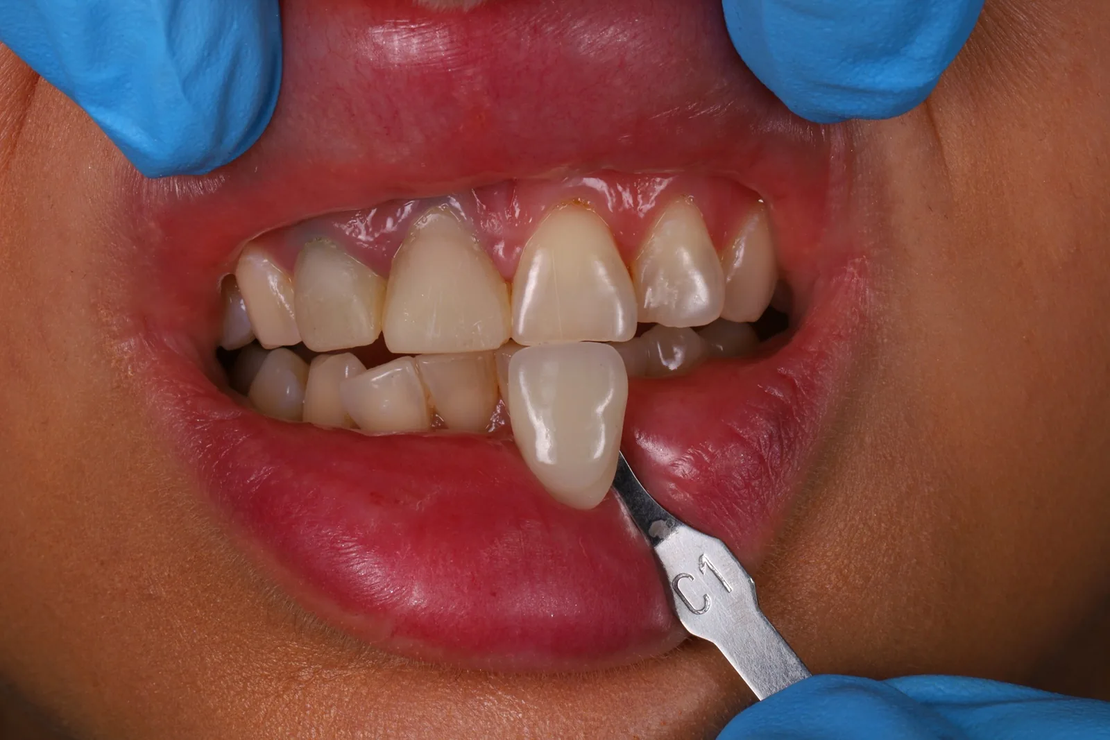 In-lab and on-site shade consultation