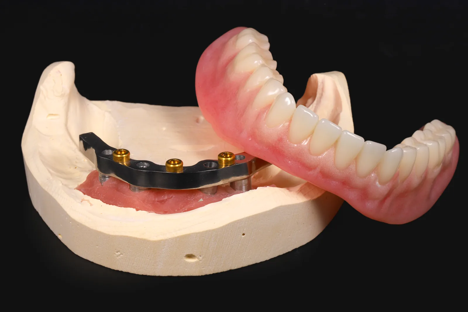Locator bar overdenture
