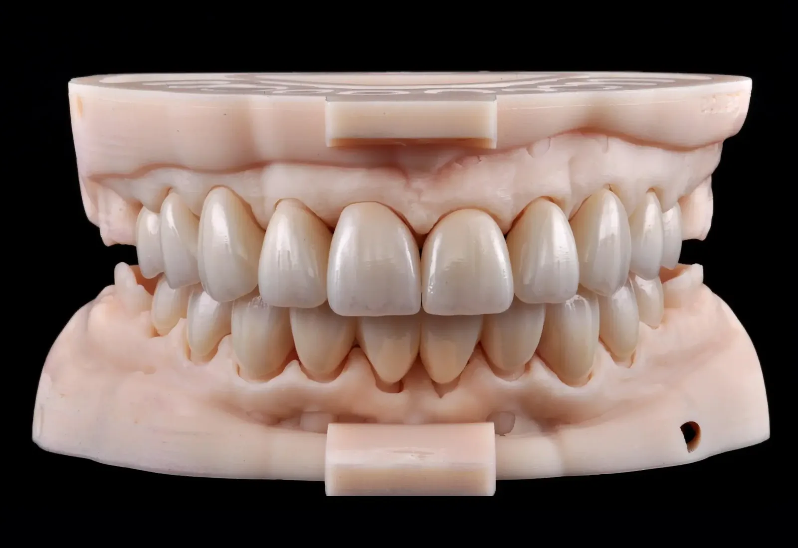 Full-arch all-ceramic zirconia restoration