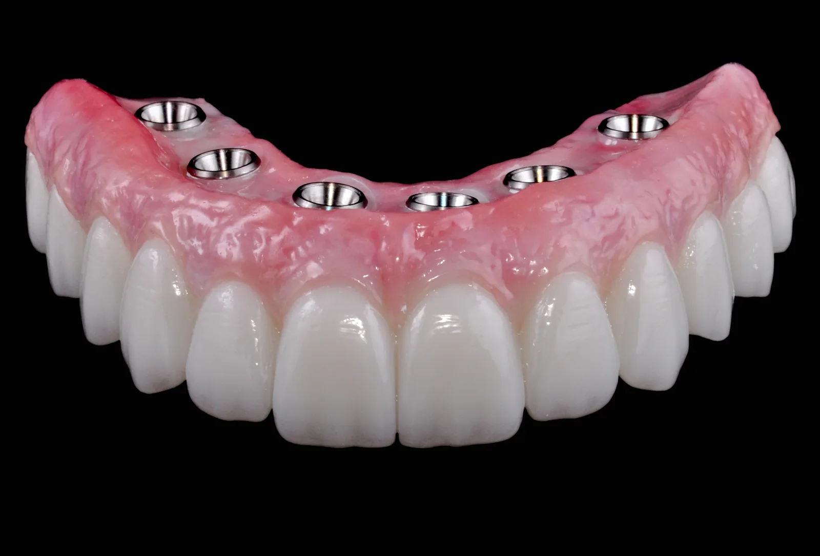 All-on-X full-arch implant restoration